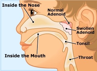 Adenoids Treatment in Homeopathy