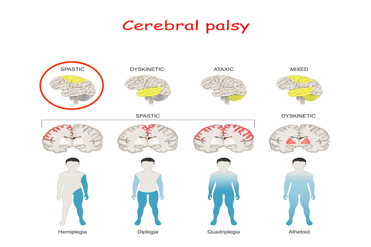 Cerebral Palsy Treatment
